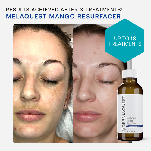 MelaQuest – Treatment - DermaQuest Clinical